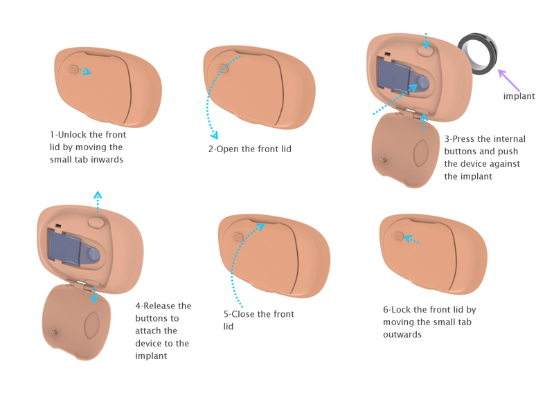 Medical Devices — Colostomy